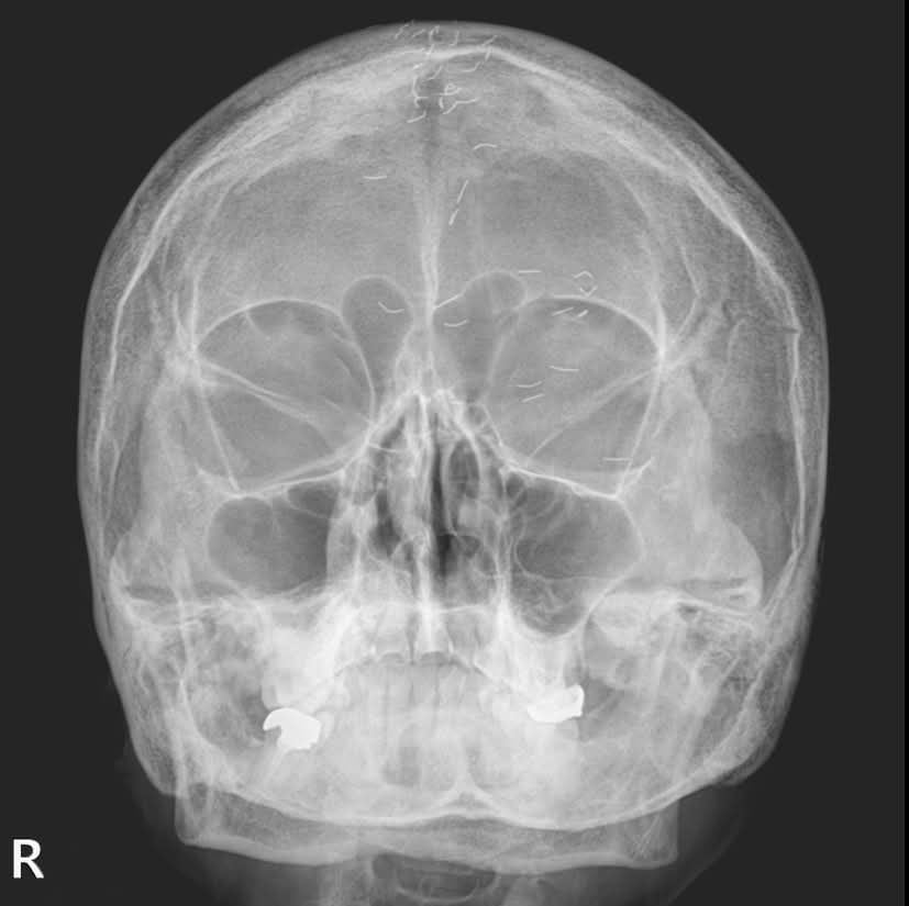 양성관 의정부백병원 가정의학과 과장이 SNS에 공개한 60대 여성 환자의 머리 엑스레이 사진 / 사진 = 양성관 의사 페이스북 캡쳐