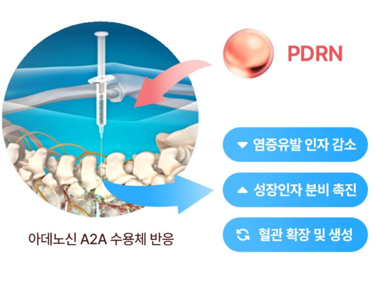 PDRN성분 약침 치료 기전