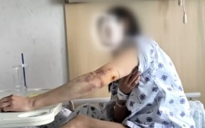 결혼식 앞두고 개에 물렸는데…견주 "뼈라도 부러졌냐"