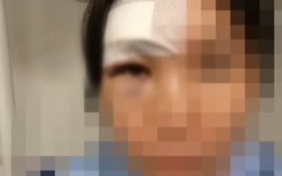 헬스장서 20kg 바벨 맞아 뇌진탕…가해자는 "돈 없다"