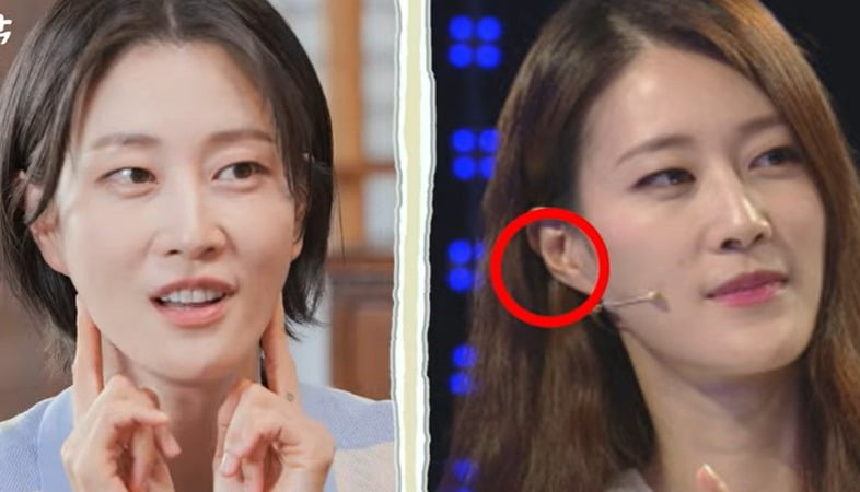 "돈이 줄줄"…이현이가 맞은 '귀 필러' 뭐길래