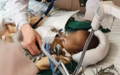 中 날아간 국내 간이식팀, 생후 6개월 아기 간이식 '성공'