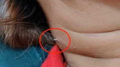 생선 먹다가 실수로 삼켰는데…목 피부 뚫고 나온 가시