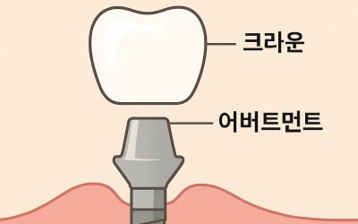 1년에 3곳 M&A…시지메드텍이 치과 상부구조물에 '올인'한 이유