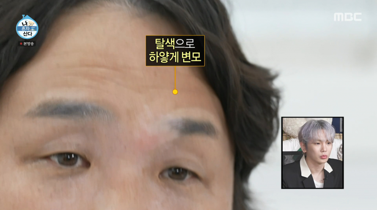 Actor Ku Sung-hwan Opens Up About Vitiligo Struggles on 'I Live Alone'