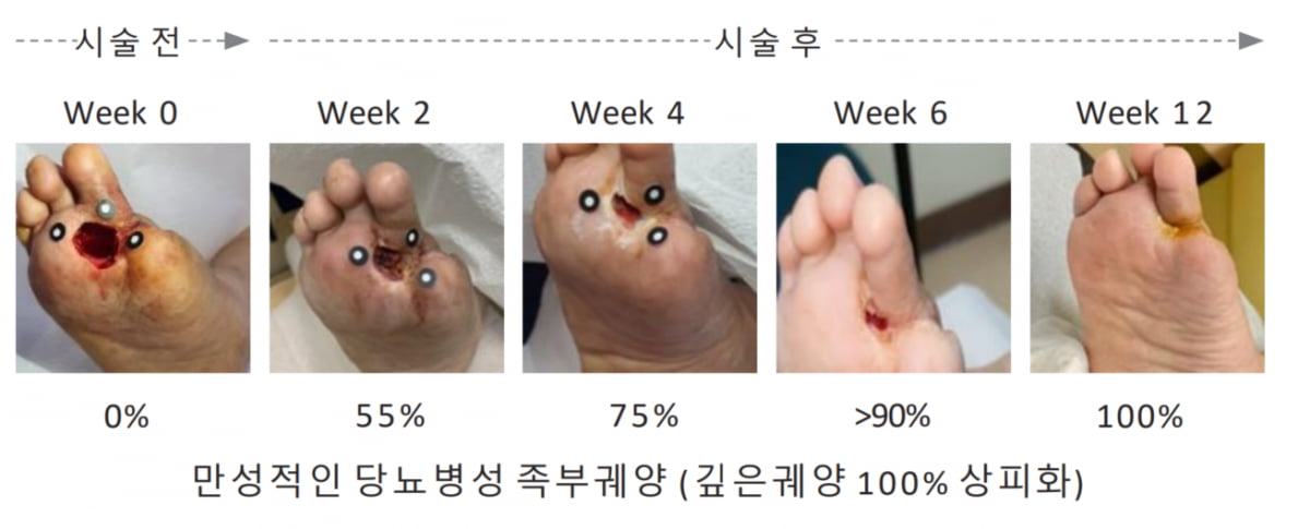 로킷헬스케어, '절단'해야 했던 당뇨발에 재생치료…임상시험 승인