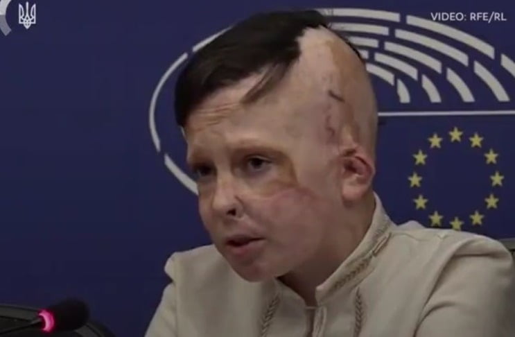 "계속 도와주세요"…35회 수술한 11세 소년의 호소