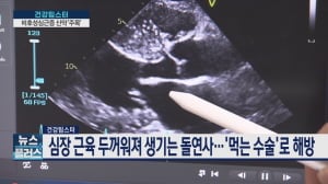 심장 근육 두꺼워져 생기는 돌연사…'먹는 수술'로 해방 [건강팁스터]
